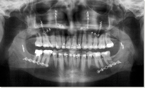 X-ray of lower face